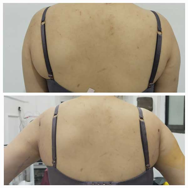 Bra Line