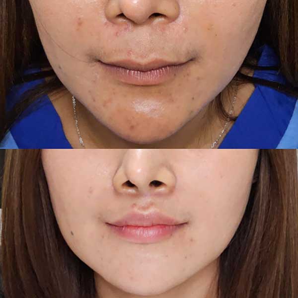 Lip Lift